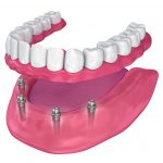 What is the approximate cost of full dental implants?